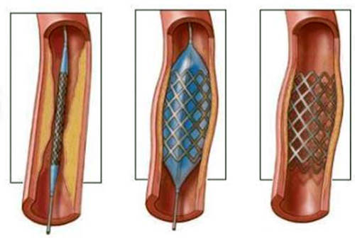 Ангиопластика: в артерию вводится катетер и продвигается по кровеносным сосудам до тех пор, пока не достигнет суженного участка. На конце катетера имеется баллончик, который надувается и сдавливает атеросклеротические наросты на стенках артерии, расширяя ее просвет